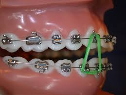 Braces Elastics – Must Read Guide!! - Dental Aware Australia
